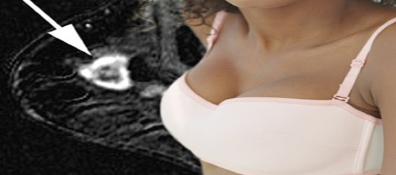 cancro-al-seno