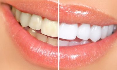 rimedi naturali per denti bianche gengive sane