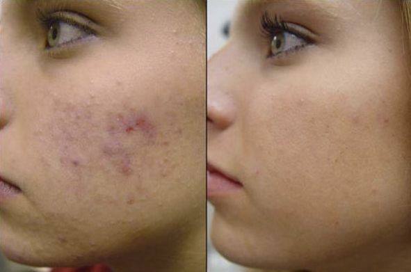 cicatrici acne rimedi naturali